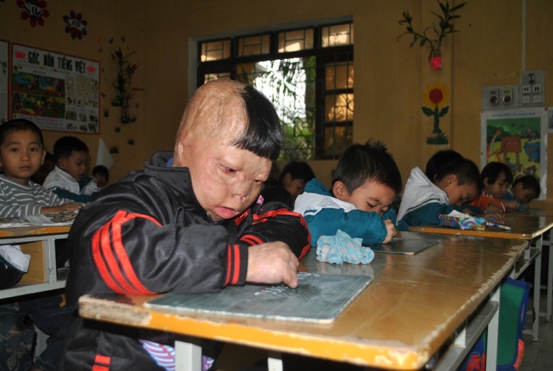 Sau khi bị bố đổ xăng thiêu đốt, tất cả tóc, mang tai, các ngón tay Linh đều bị cháy hoàn toàn. Các bác sĩ đã phải lấy thịt người mẹ cấy vào tạo ngón tay giả cho bé. Dù vậy, Linh viết chữ rất đẹp, hăng hái tham gia phát biểu ý kiến. Ảnh: Duy Cảnh.