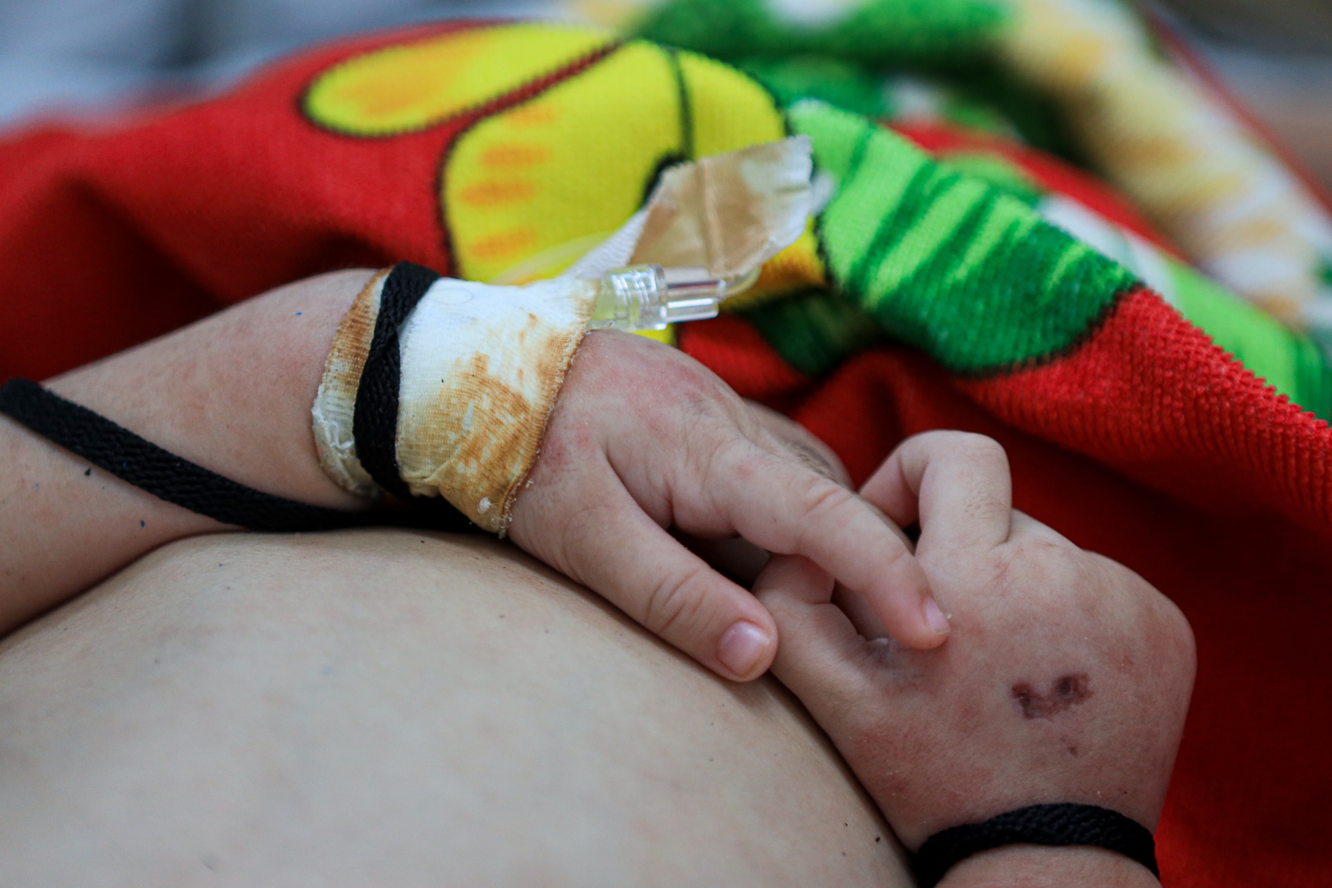 Mot dau hieu dac trung it duoc de y cua benh soi hinh anh