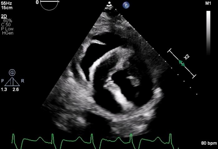 Bi an cai chet cua nguoi dau tien duoc ghep tim lon hinh anh