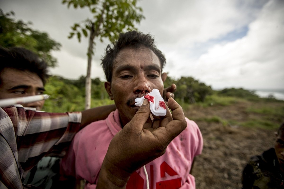 Lễ hội Pasola phải tiếp tục cho tới khi đổ máu. Nếu không có máu thì sẽ không có vụ mùa. Người đàn ông này bị giáo đâm trúng mặt, rách mũi.