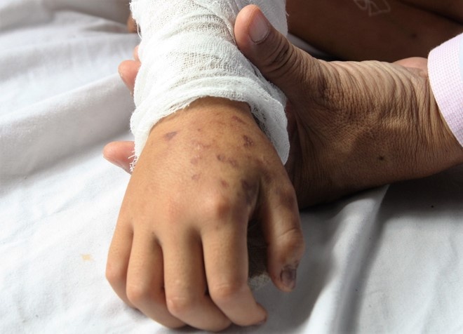 xu ly nguoi bi ran can anh 1