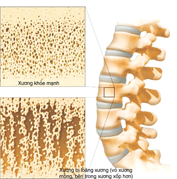 Khi nao can do mat do xuong? hinh anh