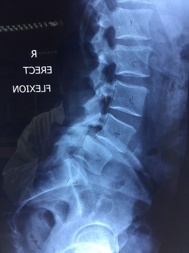 Phau thuat cot song cho benh nhan nuoc ngoai hinh anh