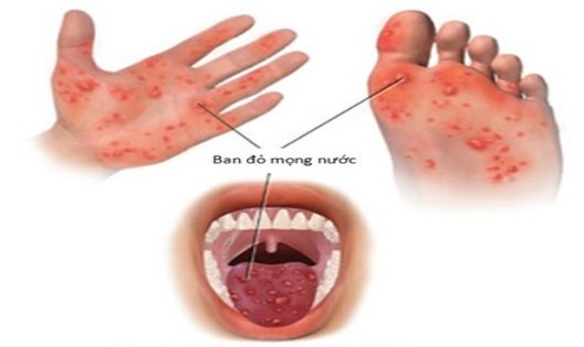 bệnh tay chân miệng ảnh 1 benh tay chan mieng anh 1