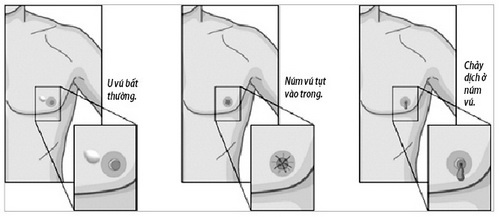 Dấu hiệu ung thư vú ở nam giới ảnh 1 Dau hieu ung thu vu o nam gioi anh 1