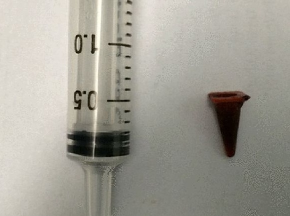 Phat hien do choi bang nhua nam trong phoi benh nhan suot 40 nam hinh anh