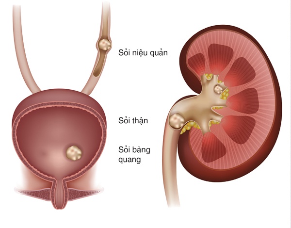 Biến chứng nguy hiểm của sỏi mật ảnh 1 Bien chung nguy hiem cua soi mat anh 1