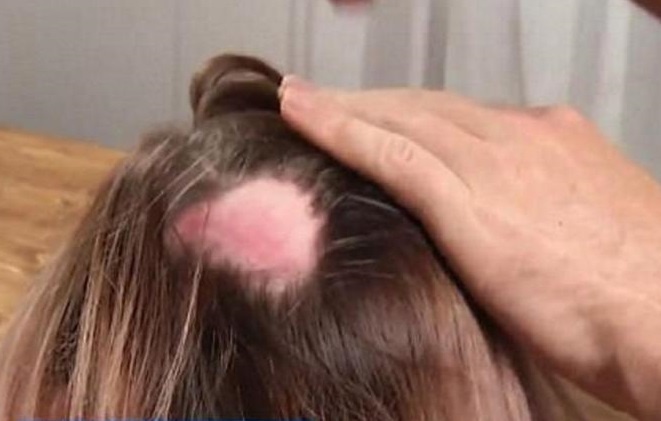 Nguoi phu nu tiet lo bi bong hoa chat sau khi nhuom toc hinh anh