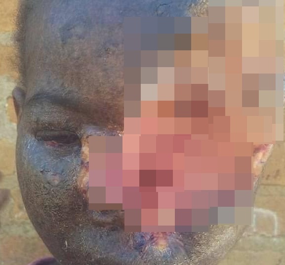 Be gai mat nua mat vi benh kho sac to da hinh anh