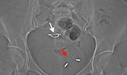 vòng tránh thai ảnh 1 vong tranh thai anh 1