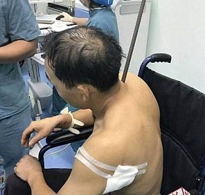 Cuu song nguoi dan ong bi thanh thep xuyen qua nguoi hinh anh