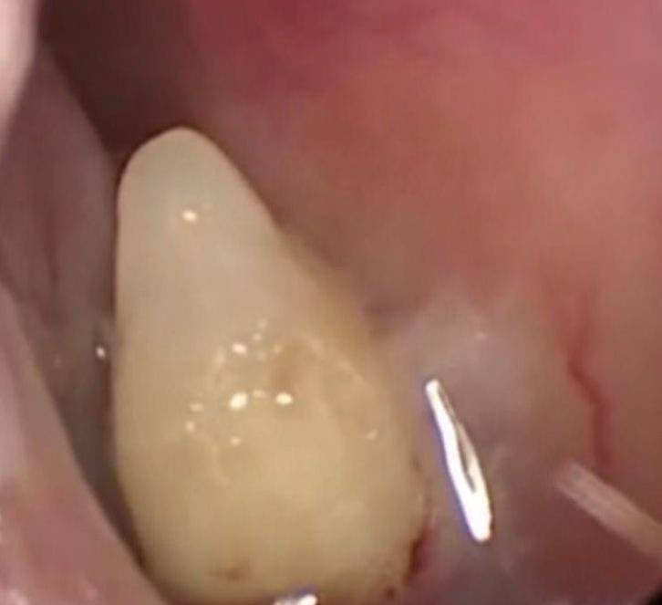 răng mọc trong mũi ảnh 1 rang moc trong mui anh 1