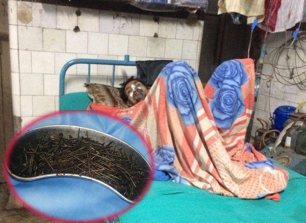 Phau thuat lay 600 dinh sat ra khoi bung benh nhan hinh anh