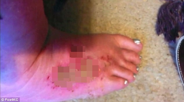 Nguoi phu nu bi bong sau khi tay chai chan o tiem lam dep hinh anh