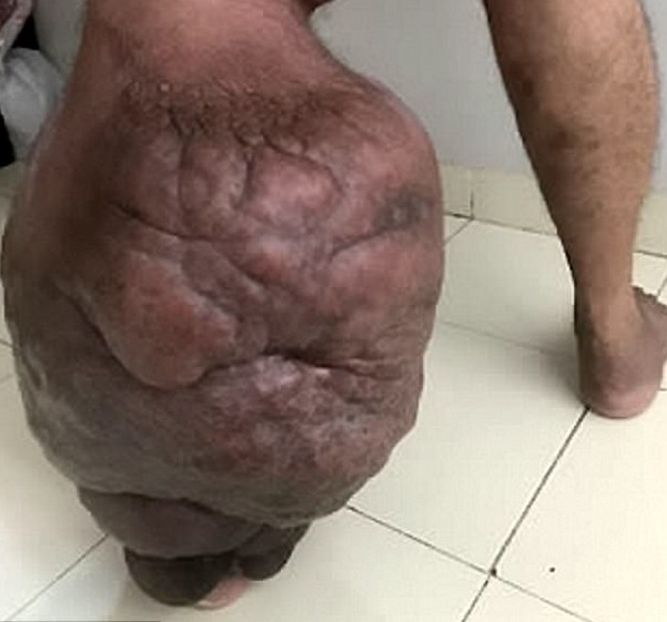 Chan phu to sau khi bi muoi can hinh anh