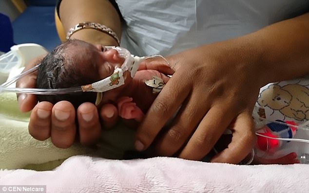 Be gai sinh non nang gan 400 gram song sot ky dieu hinh anh