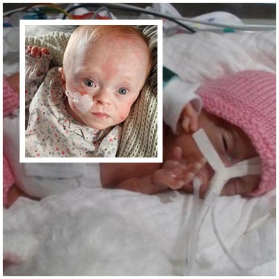 Be gai sinh non nhe nhat the gioi van song sot hinh anh