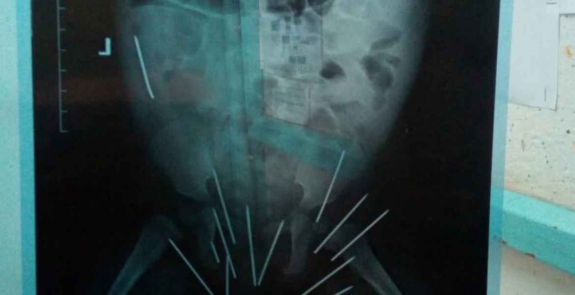 Be 10 thang tuoi co 14 cay kim trong mong hinh anh