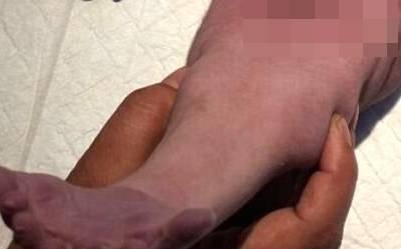 hội chứng người cá ảnh 1 hoi chung nguoi ca anh 1