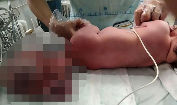 thai nhi ký sinh ảnh 1 thai nhi ky sinh anh 1