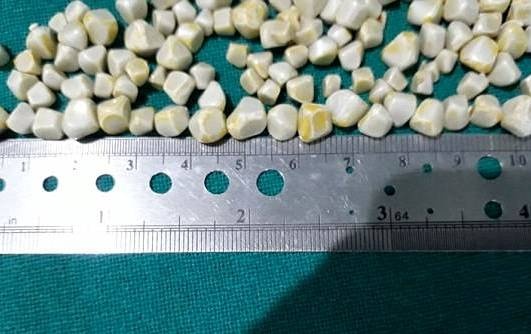 Nguoi phu nu mang 148 vien soi trong tui mat hinh anh