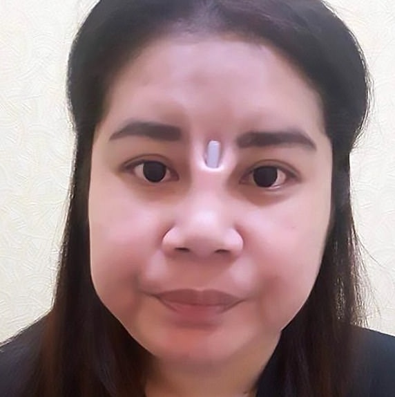 nâng mũi hỏng ảnh 1 nang mui hong anh 1