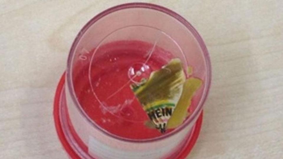 Bi chan doan mac benh man tinh vi manh nylon nam trong bung suot 2 nam hinh anh