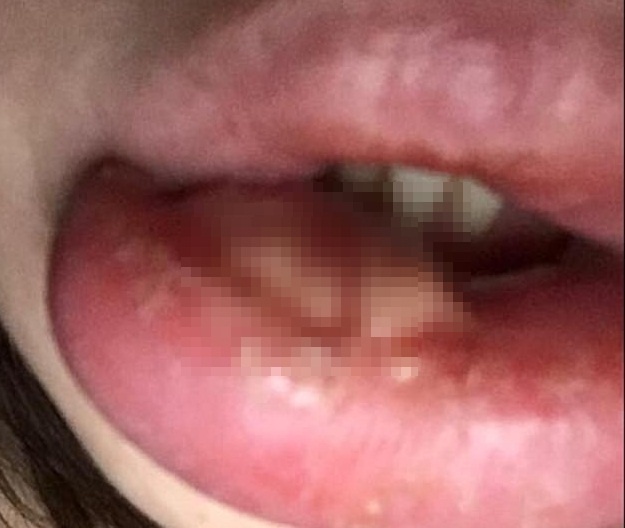 bơm môi ảnh 1 bom moi anh 1