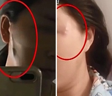 Nguoi phu nu moc khoi u la tren mat sau khi 'dao keo' hinh anh