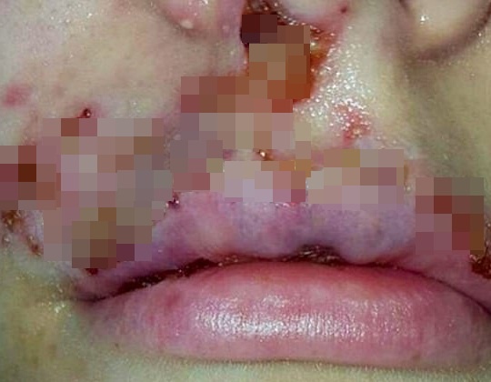 Moi phong rop sau khi tiem chat lam day hinh anh