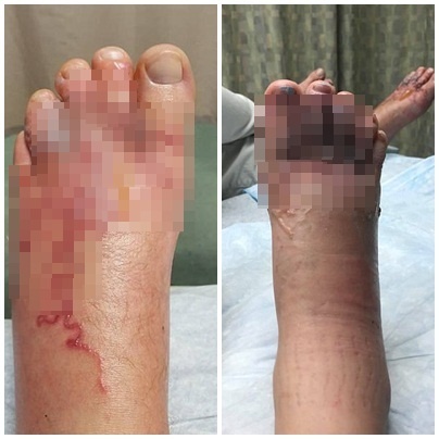 giun móc chui vào chân ảnh 1 giun moc chui vao chan anh 1