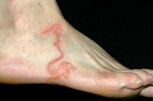 Chan sung tay do giun moc ky sinh sau khi du lich bien hinh anh