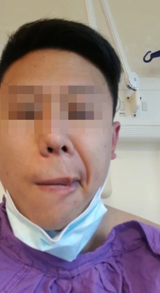 bi liet mat sau khi tiem vaccine anh 1