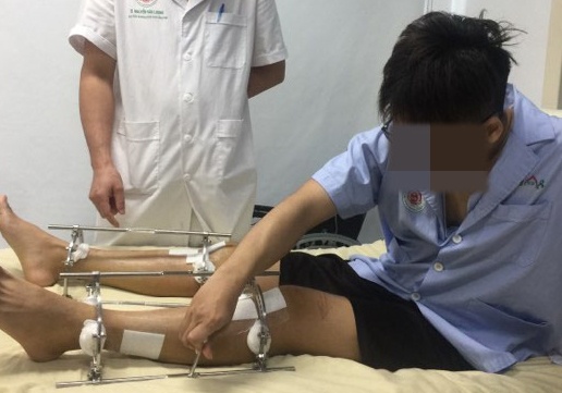 Chang trai phau thuat keo dai chan de cao tren 1,73 m hinh anh