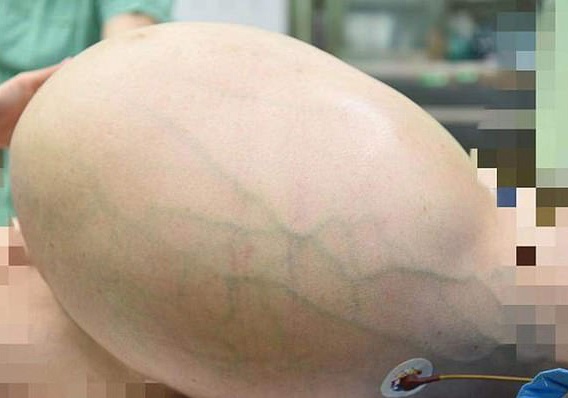 Bung to nhu mang song thai vi khoi u 35 kg trong buong trung hinh anh