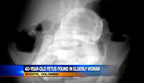 Bao thai hoa da 40 nam trong bung ba bau hinh anh