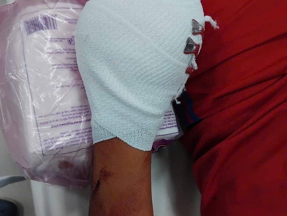 Bi thuong tich nang do dot phao 'tu che' don giao thua hinh anh