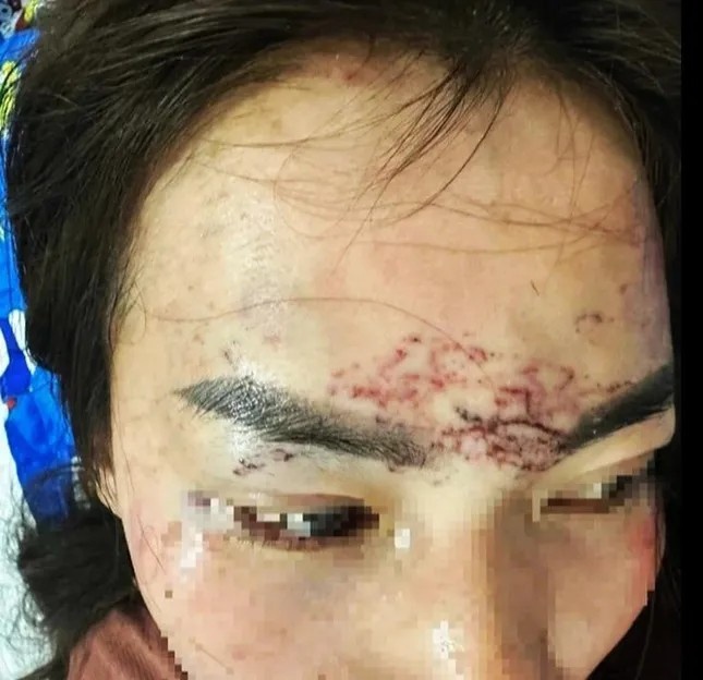 phu nu danh ghen,  do axit,  xam mat nguoi khac anh 1