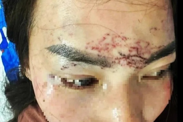 Dien bien vu 2 phu nu danh ghen, do axit, xam mat nguoi khac o Ca Mau hinh anh