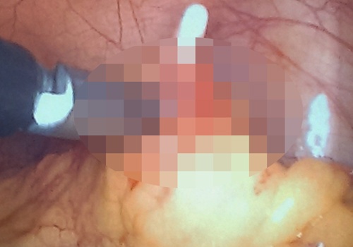 Co gai 25 tuoi bi vong tranh thai lot vao o bung hinh anh