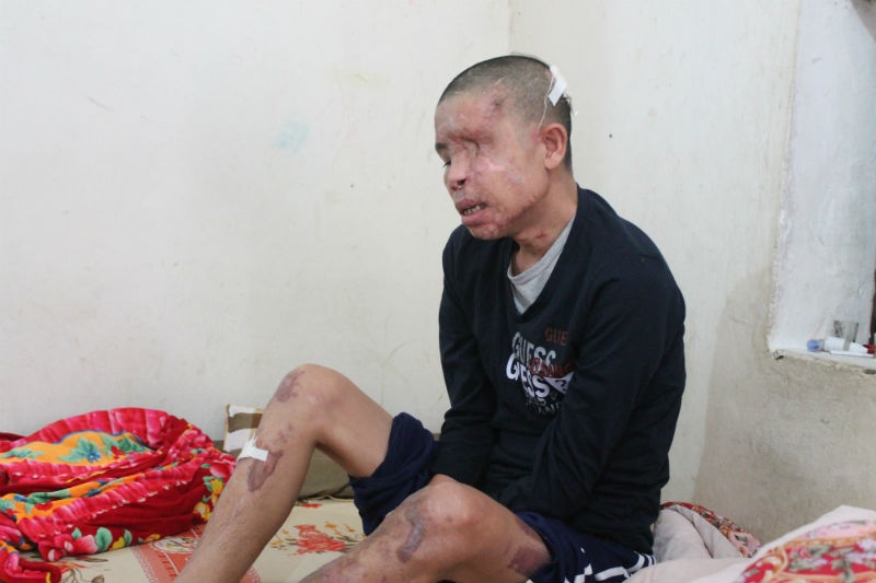 2 tháng sau vụ nổ kinh hoàng, người viết không khỏi xót xa khi gặp lại anh Thái Viết Hảo (SN 1980, trú xóm Đông Vạn, xã Nghi Vạn, Nghi Lộc, Nghệ An). Trên chiếc giường cũ kỹ, giường như là một ông lão 70 tuổi chứ không phải là người đàn ông đang tuổi sung sức nhất và là trụ cột của gia đình!