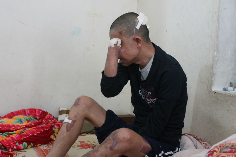 Vụ nổ kinh hoàng cuối tháng 9/2014 đã lấy đi vĩnh viễn của anh đôi tay và cặp mắt. Anh Hảo bị chấn thương sọ não, nằm hôn mê nhiều ngày trong bệnh viện. “Tôi tỉnh dậy và muốn chết đi vì cơ thể này không phải của mình nữa, tôi chỉ trở thành gánh nặng cho vợ con”, anh Hảo lấy khuỷu tay cụt ngủn gạt nước mắt nói nghẹn ngào.