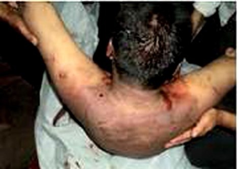 Thi thể nạn nhân Ngài bị bầm dập, tím tái sau khi tử vong và được cơ quan điều tra kết luận chết do điện giật vì tự tử. Ảnh người nhà nạn nhân cung cấp.