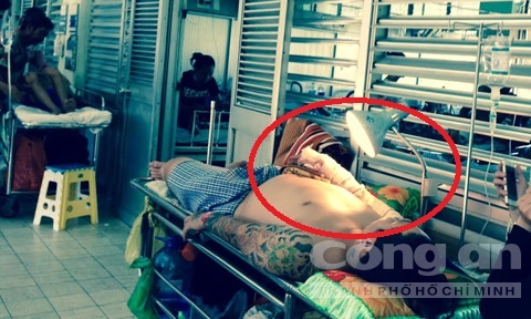 Các bác sĩ đã thực hiện ca phẫu thuật nối bàn tay phải cho anh Nam.