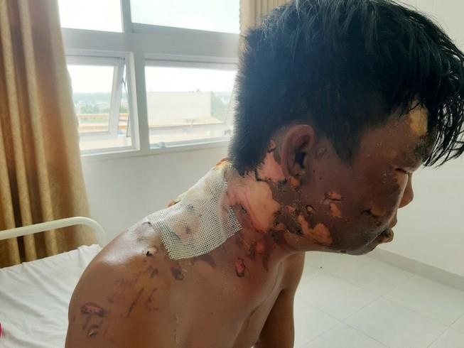 Chi tat nuoc soi khien em trai bong nang hinh anh