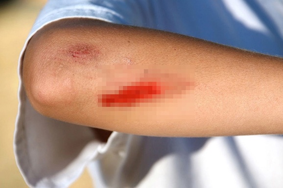 Tieu het tien, nguoi phu nu tu gay thuong tich roi bao bi cuop hinh anh