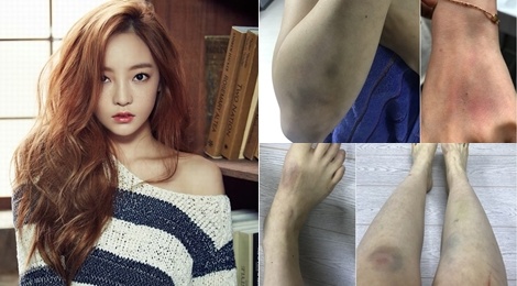 Goo Hara cong bo anh bi ban trai danh bam dap, chay mau tu cung hinh anh