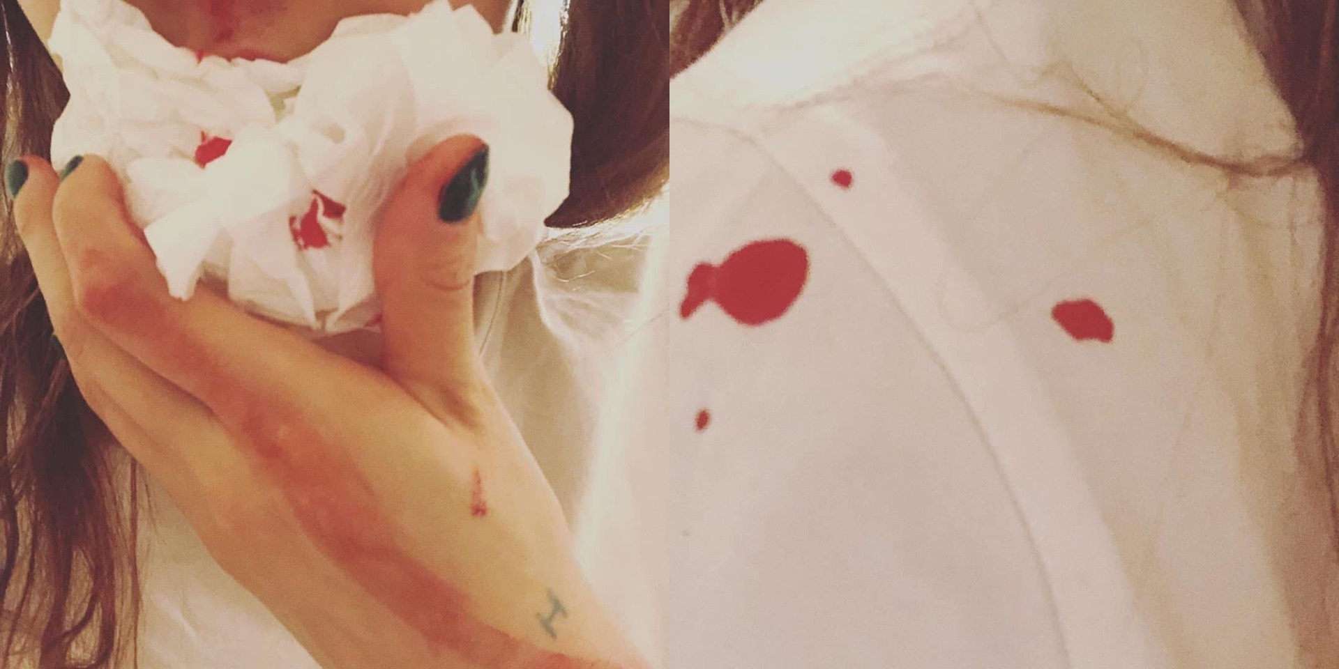 HyunA bi chay mau cam anh 1