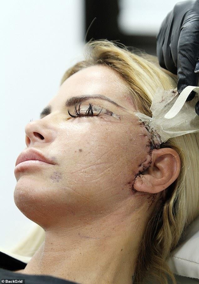 Katie Price sợ bị rơi mất tai sau khi phẫu thuật ảnh 1 Katie Price so bi roi mat tai sau khi phau thuat anh 1