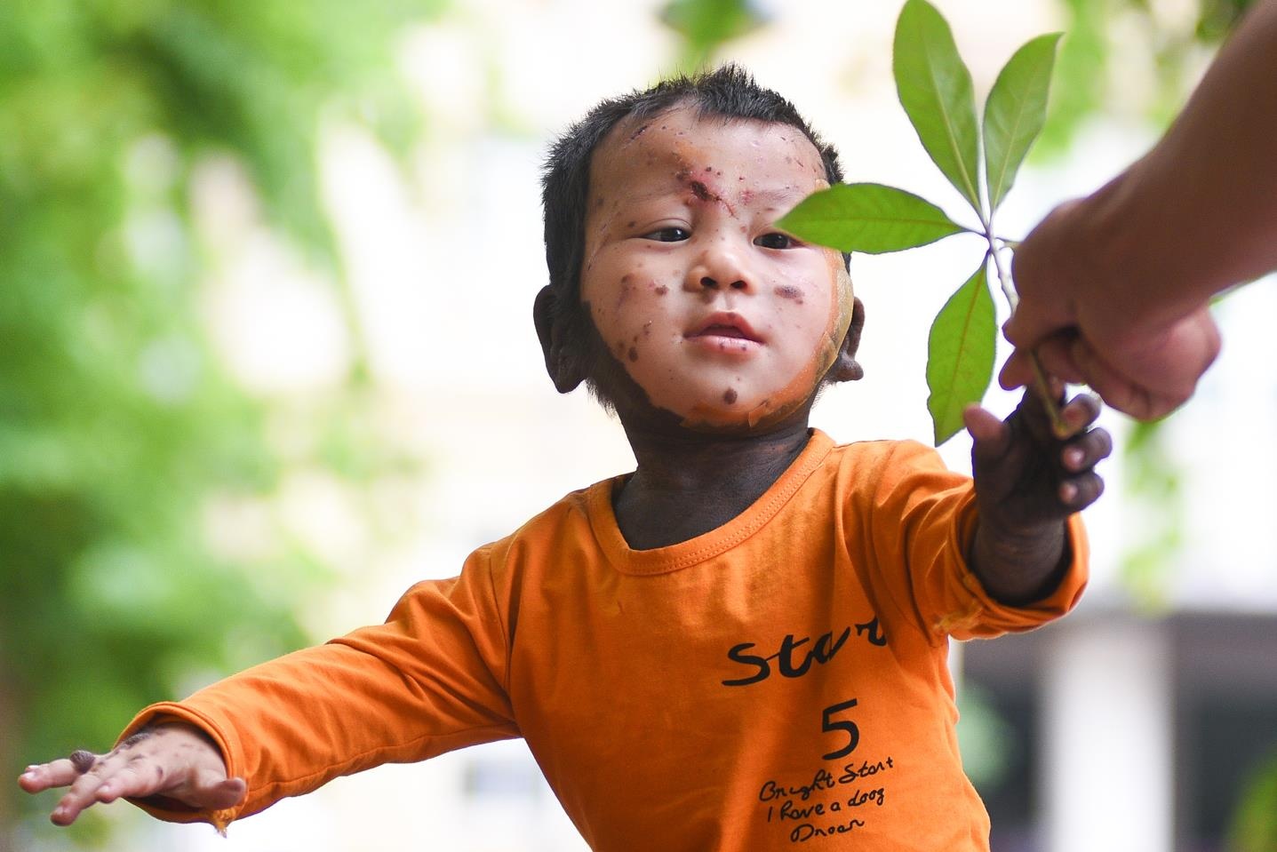 Hanh trinh tim lai mau da cho cau be dac biet hinh anh